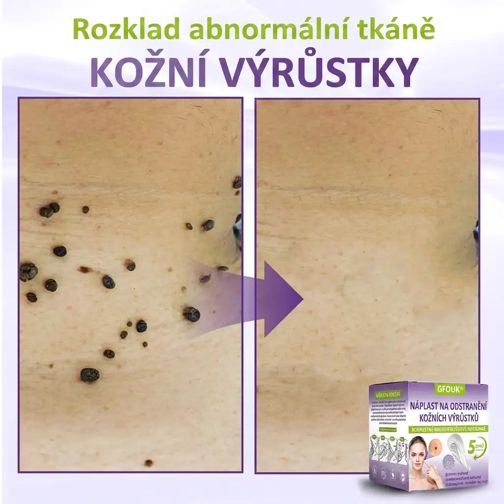 GFOUK® | 🇨🇿🩺 Rozpustná botanická mikrojehličková náplast na odstranění kožních výrůstků a znamének 🧪🌿 — Odstraní výrůstky za pouhých 5 dní, bezbolestně a bez jizev
