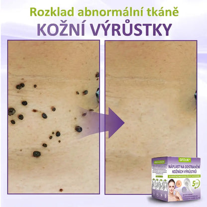 GFOUK® | 🇨🇿🩺 Rozpustná botanická mikrojehličková náplast na odstranění kožních výrůstků a znamének 🧪🌿 — Odstraní výrůstky za pouhých 5 dní, bezbolestně a bez jizev