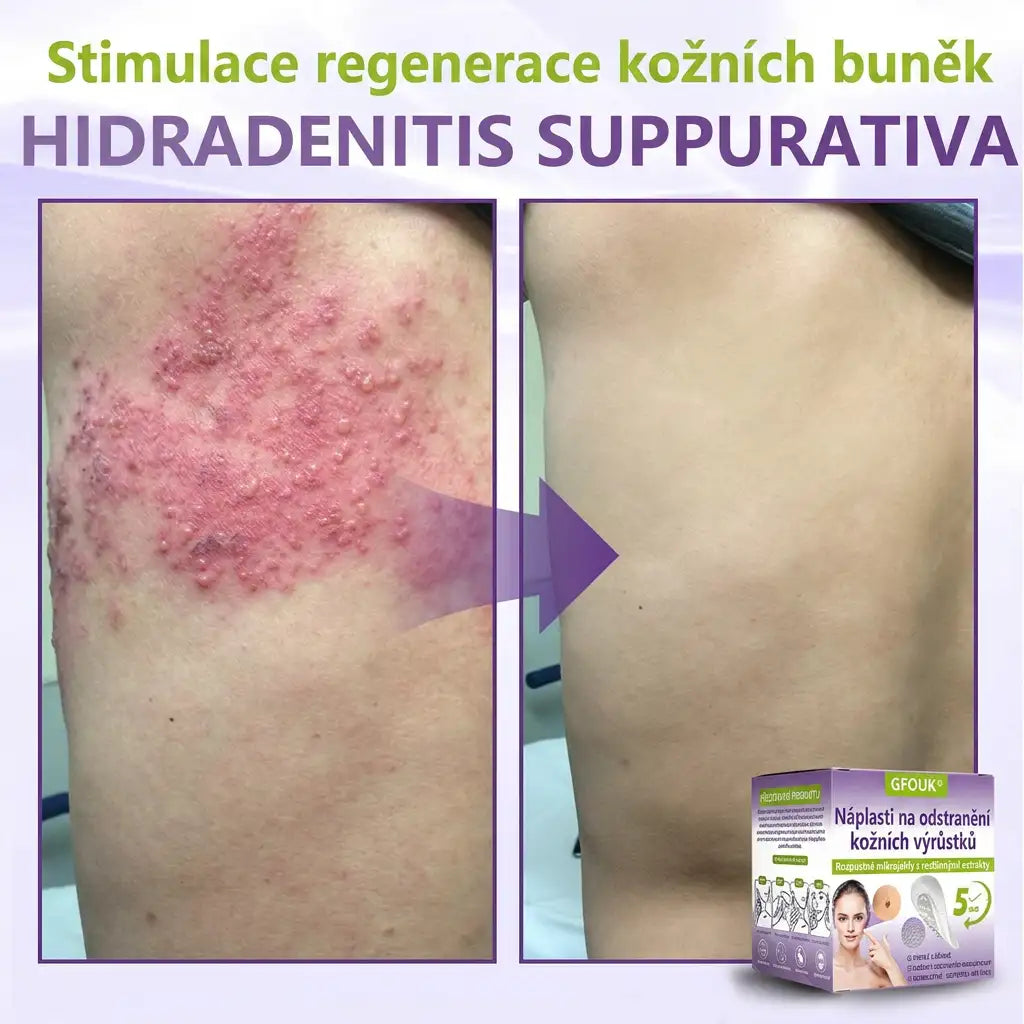 GFOUK® | 🇨🇿🩺 Rozpustná botanická mikrojehličková náplast na odstranění kožních výrůstků a znamének 🧪🌿 — Odstraní výrůstky za pouhých 5 dní, bezbolestně a bez jizev