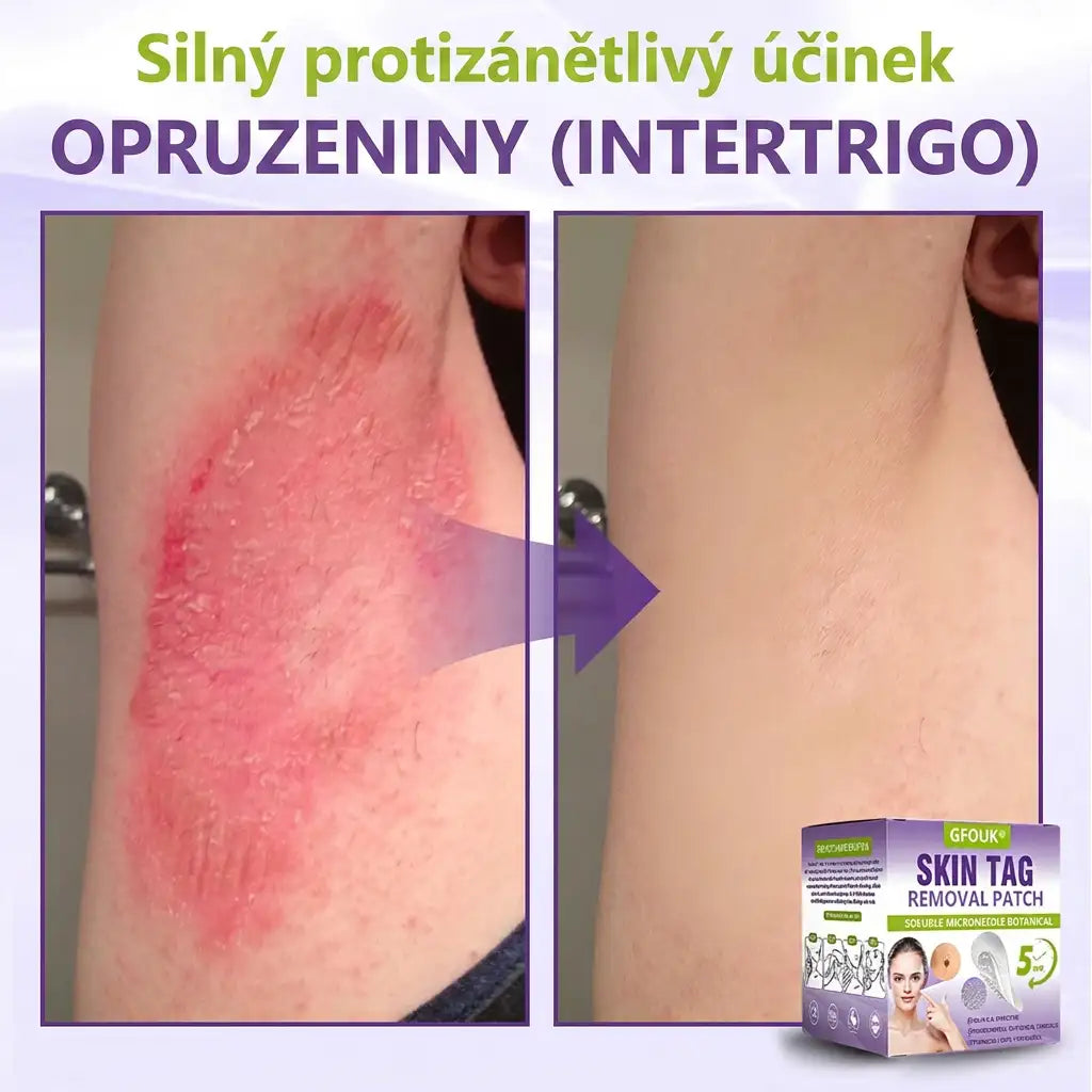GFOUK® | 🇨🇿🩺 Rozpustná botanická mikrojehličková náplast na odstranění kožních výrůstků a znamének 🧪🌿 — Odstraní výrůstky za pouhých 5 dní, bezbolestně a bez jizev
