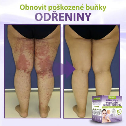 GFOUK® | 🇨🇿🩺 Rozpustná botanická mikrojehličková náplast na odstranění kožních výrůstků a znamének 🧪🌿 — Odstraní výrůstky za pouhých 5 dní, bezbolestně a bez jizev