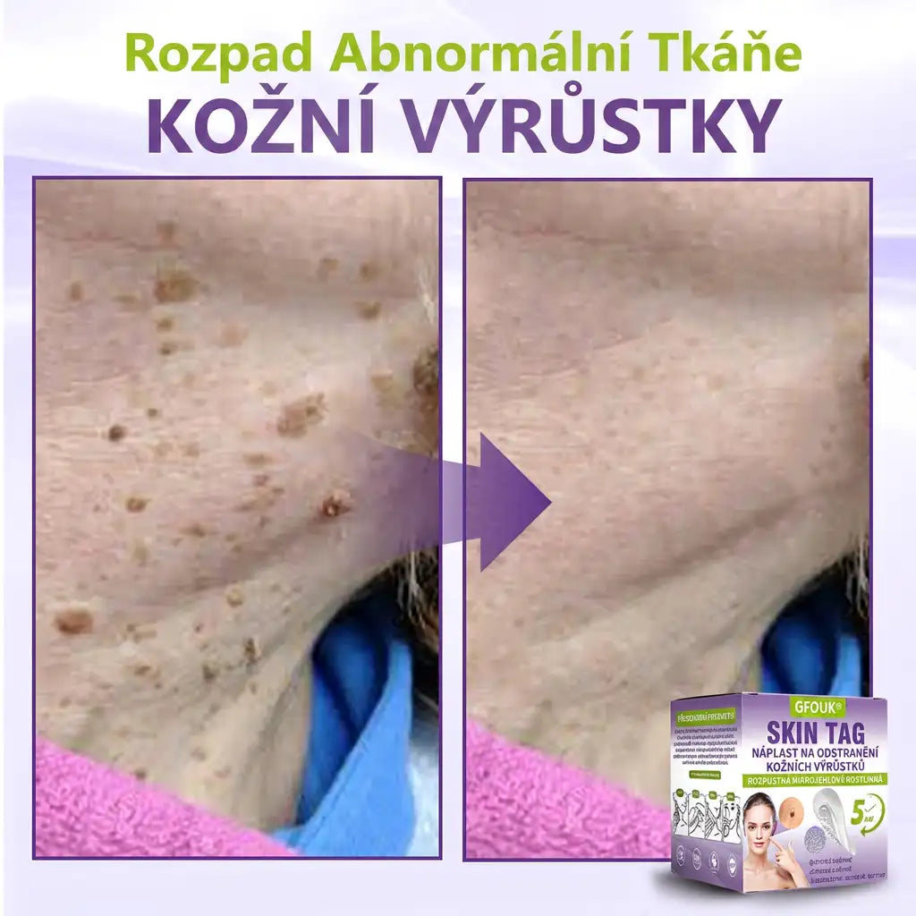 GFOUK® | 🇨🇿🩺 Rozpustná botanická mikrojehličková náplast na odstranění kožních výrůstků a znamének 🧪🌿 — Odstraní výrůstky za pouhých 5 dní, bezbolestně a bez jizev