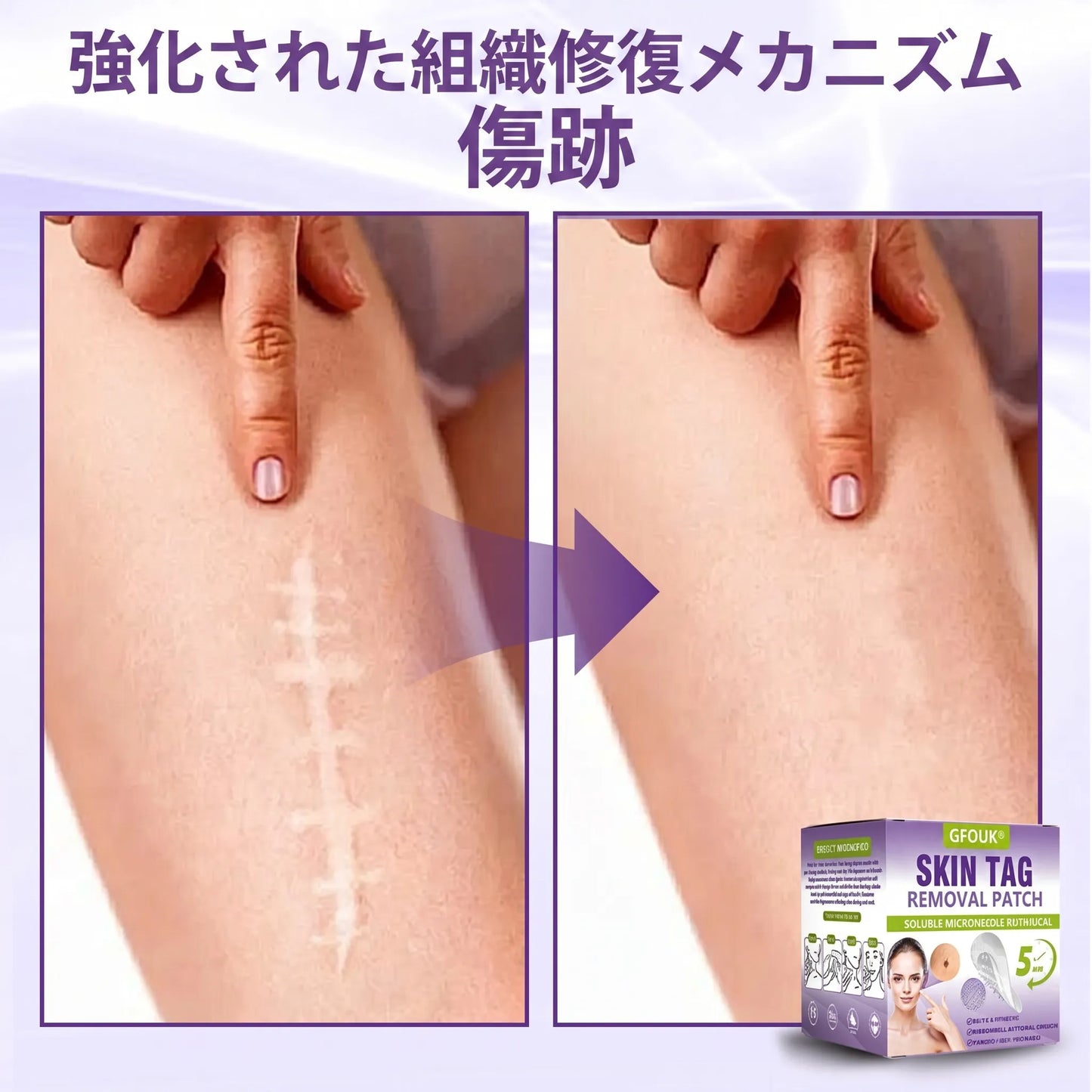 GFOUK® Soluble Microneedle Botanical Skin Tag Removal Patch