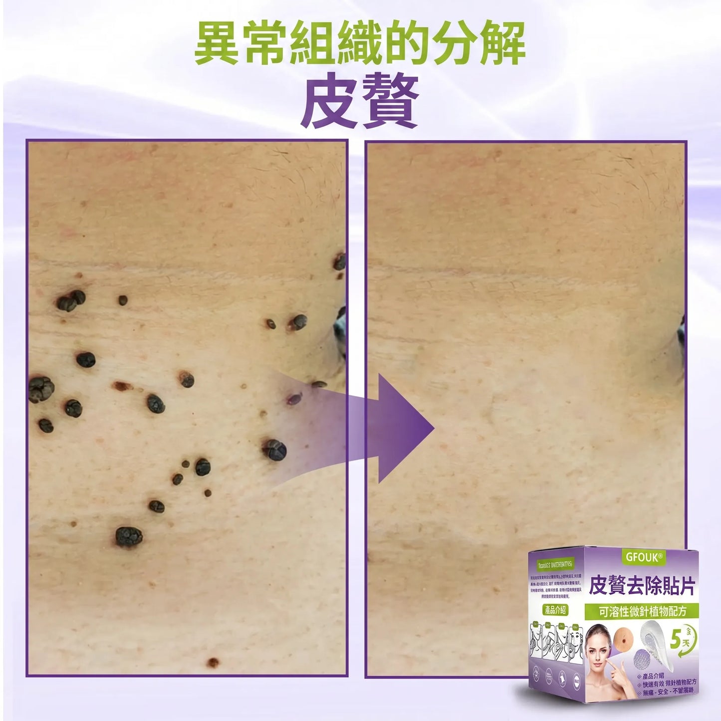 植萃微晶護理貼｜小肉芽、凸起瑕疵與痣斑肌膚專用貼片，居家溫和貼敷、隱形服貼不尷尬
