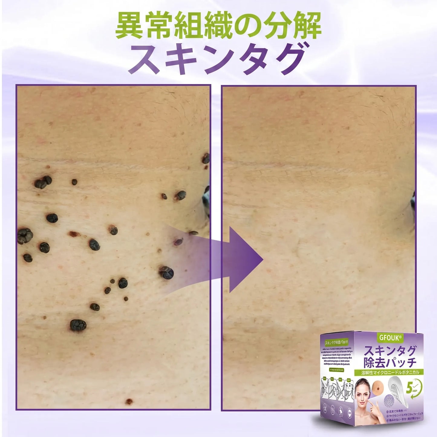 GFOUK® Soluble Microneedle Botanical Skin Tag Removal Patch
