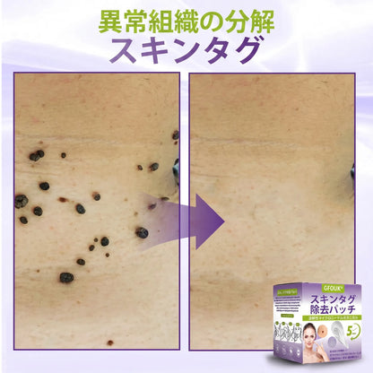 GFOUK® Soluble Microneedle Botanical Skin Tag Removal Patch