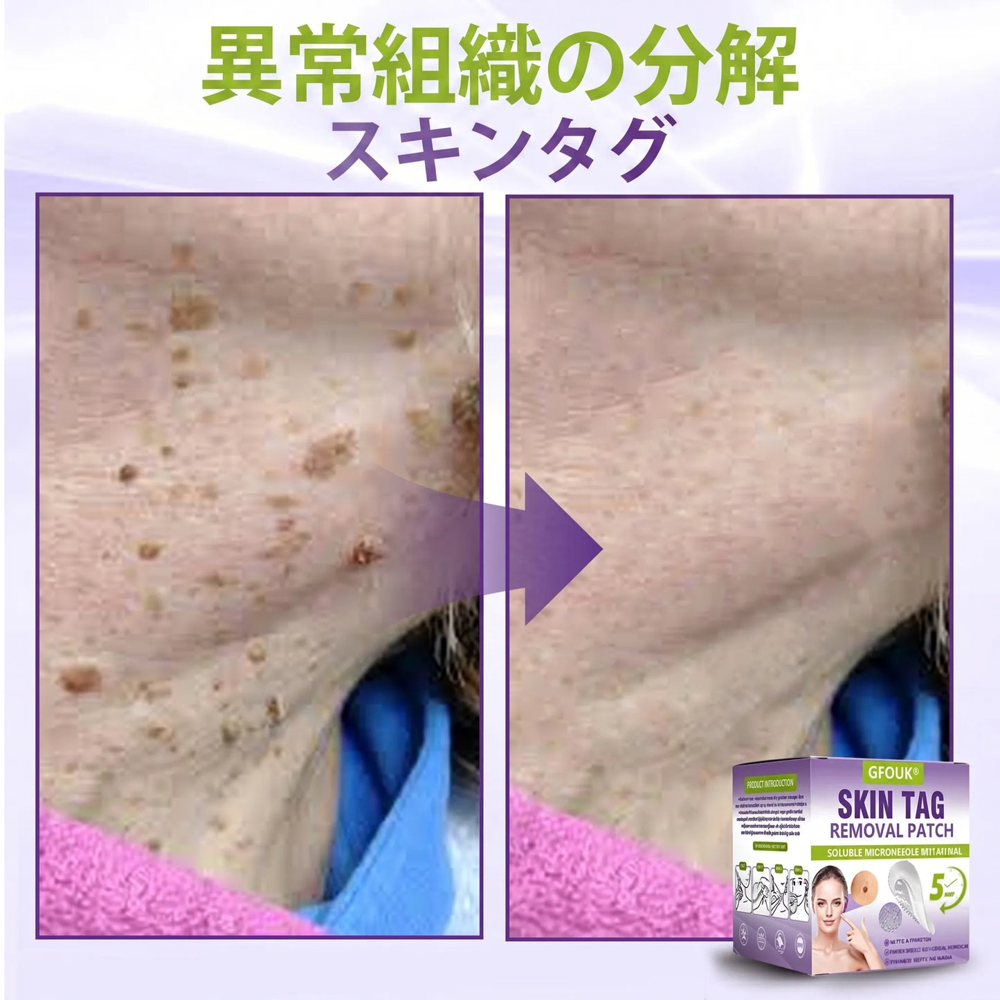 GFOUK® Soluble Microneedle Botanical Skin Tag Removal Patch