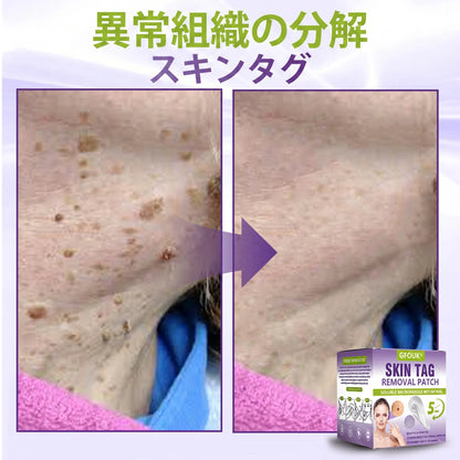 GFOUK® Soluble Microneedle Botanical Skin Tag Removal Patch